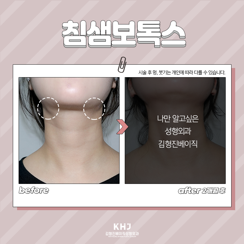 침샘보톡스유지기간 확인하세요! 관련 이미지 3