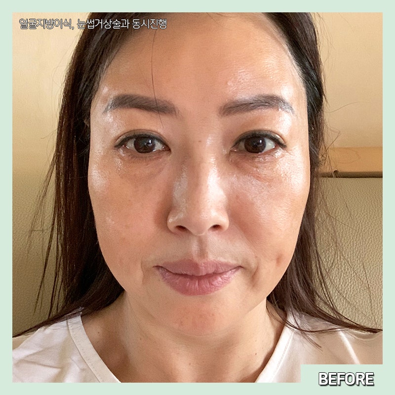 미니하안검수술 아직도 모르시나요? 관련 이미지 3