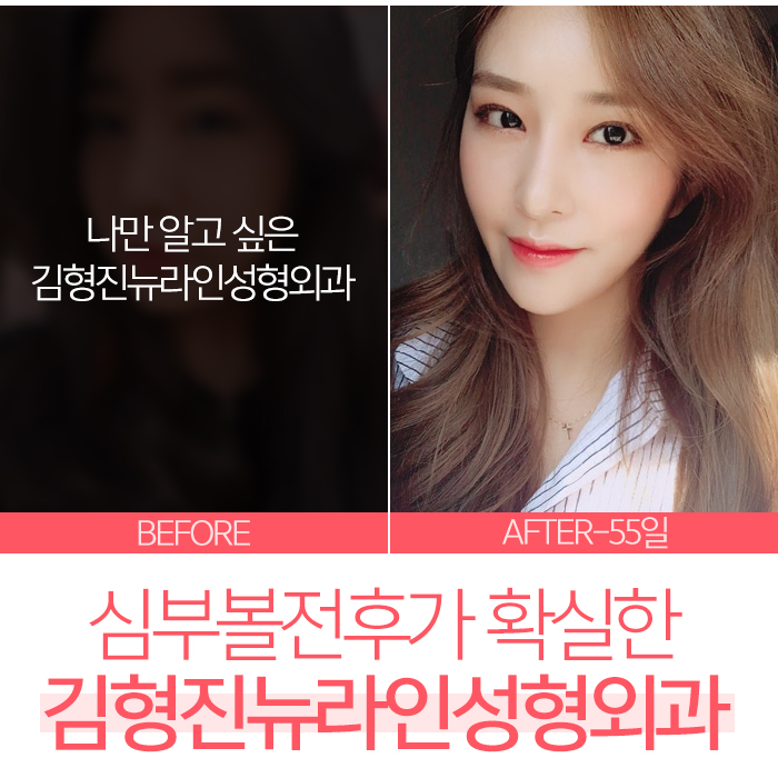심부볼제거전후 김형진뉴라인성형외과에서 관련 이미지 6