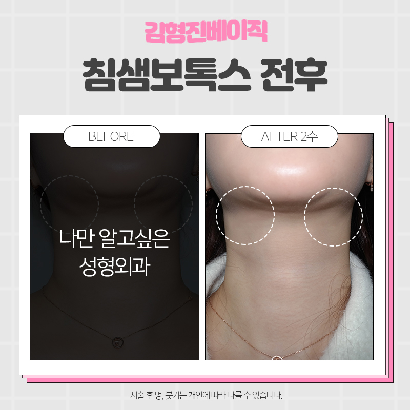 침샘보톡스잘하는곳 입소문 나는 곳은 다 이유가 있습니다 관련 이미지 6