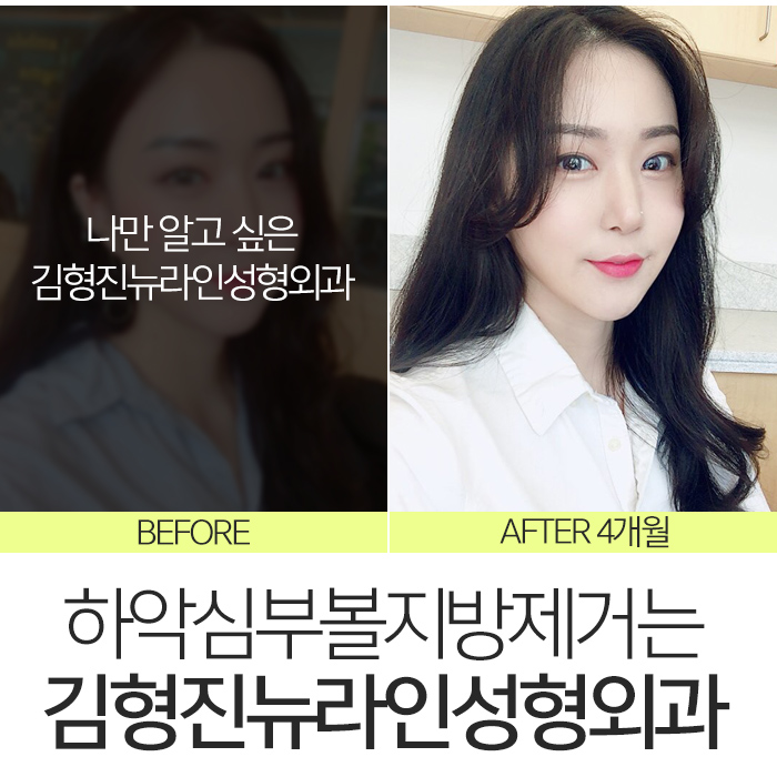 하악심부볼지방제거 잘하는곳에서 해야죠 관련 이미지 2