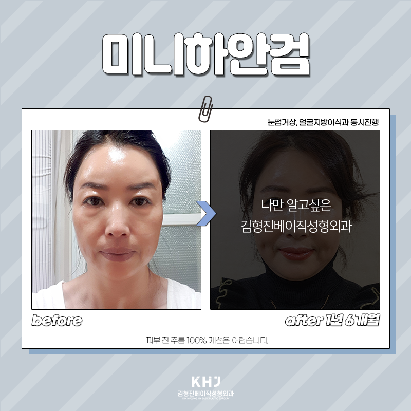 중년눈밑처짐 개선방법 알려드려요! 관련 이미지 4