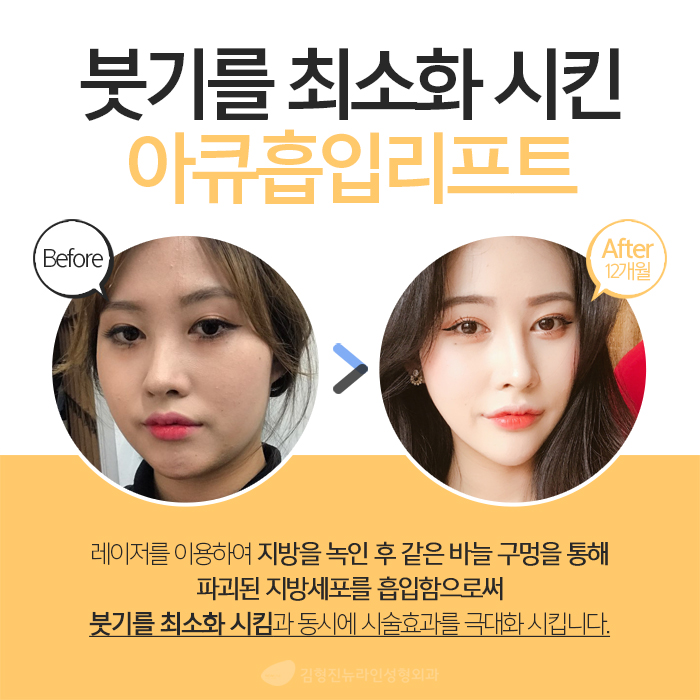 얼굴지방흡입붓기 솔직히 없을 순 없어요 관련 이미지 5