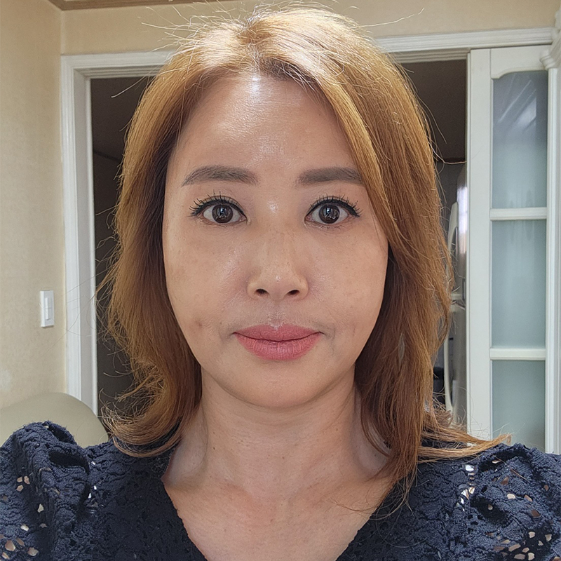 중년눈밑처짐 수술방법 알려드려요! 관련 이미지 1