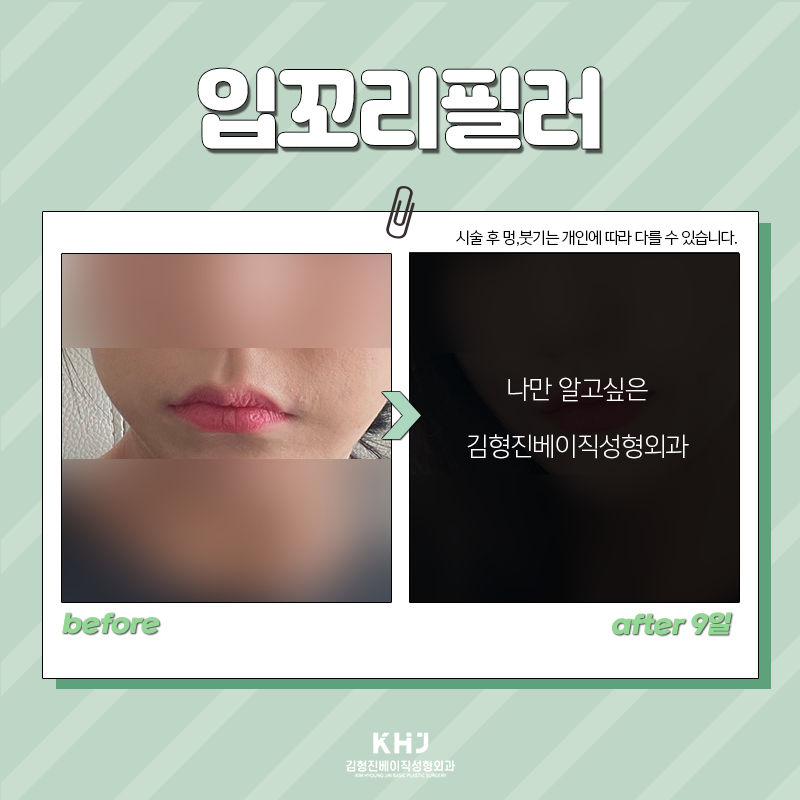 입꼬리비대칭 김형진베이직에서 개선 가능합니다! 관련 이미지 5