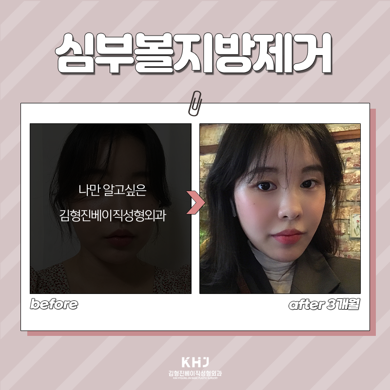 심부볼지방제거후기 보고 가세요! 관련 이미지 4