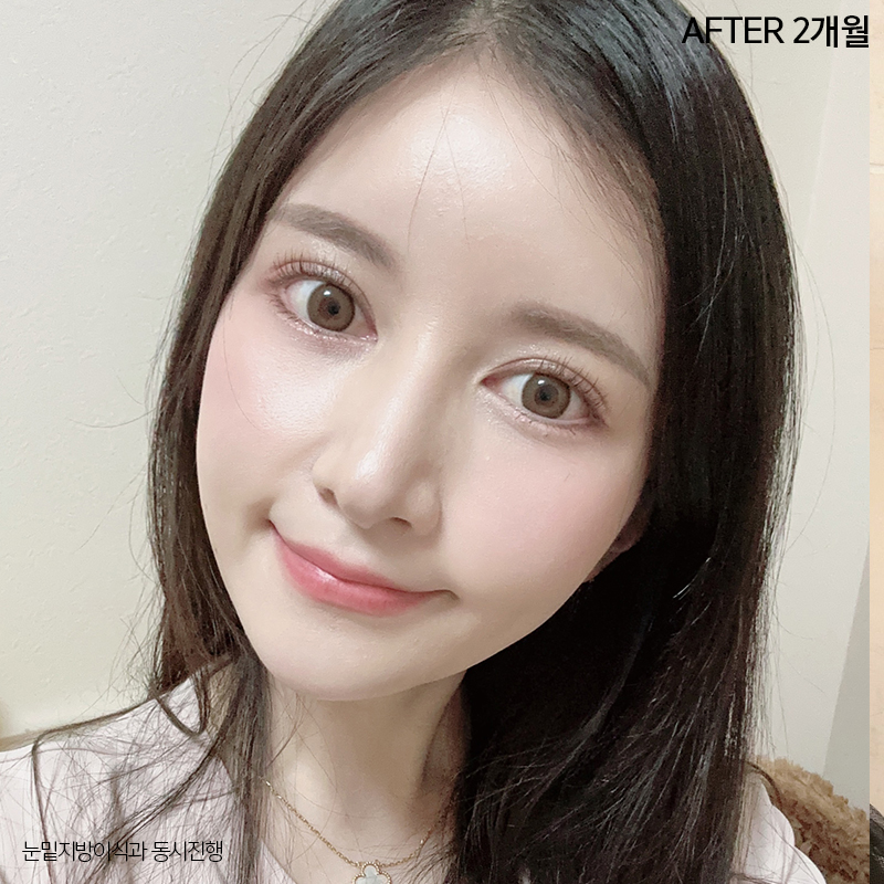 눈밑지방재배치효과 궁금하시죠? 관련 이미지 5