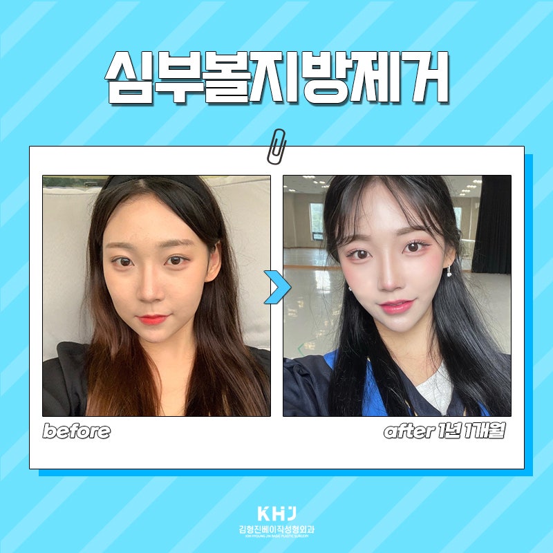 심부볼제거잘하는곳에서 볼살 없애고 왔어요! 관련 이미지 5