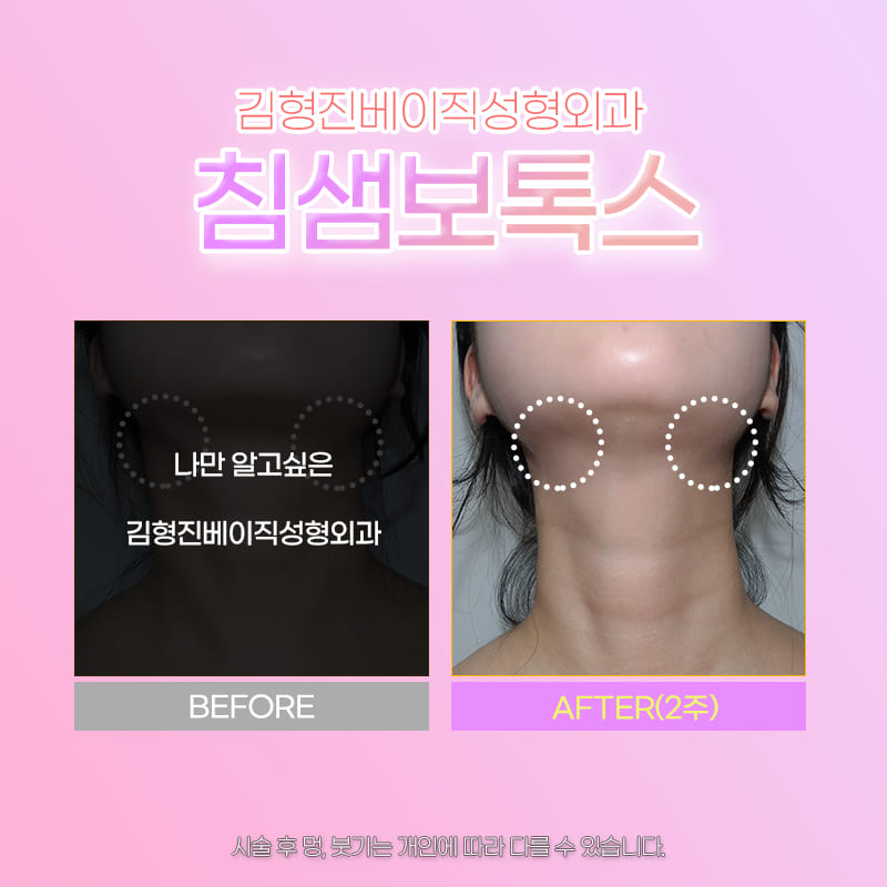 침샘비대증치료는 경험이 많은 곳에서 관련 이미지 5