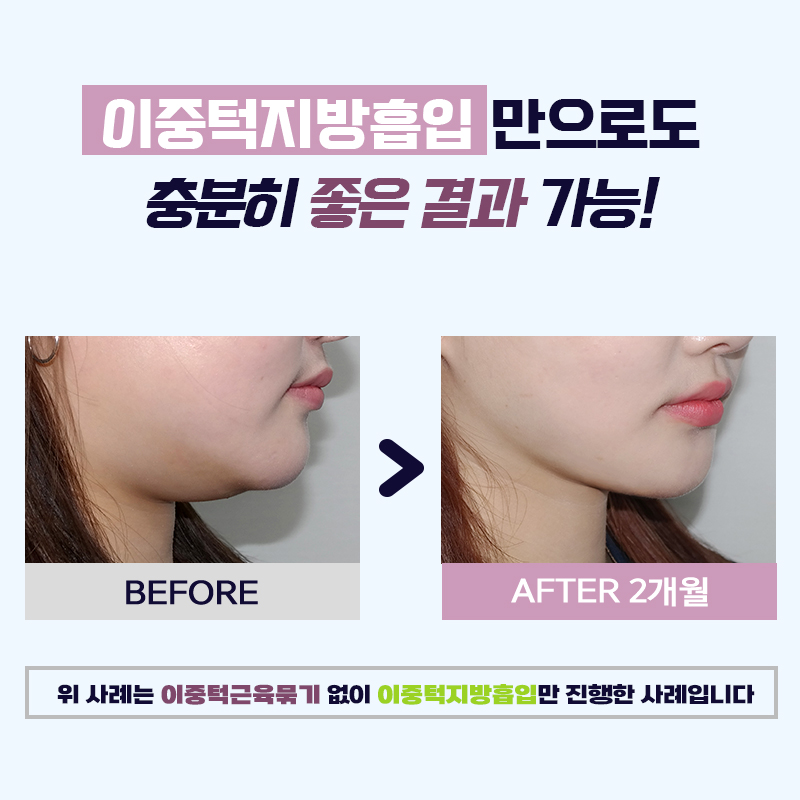 이중턱제거방법 더이상 필요 없어졌어요! 관련 이미지 5