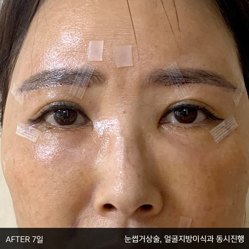 중년눈밑지방수술 아직 모르신다면 관련 이미지 4