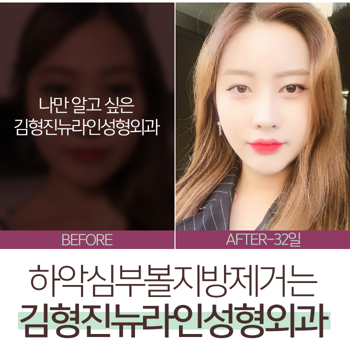 심술보제거 어떻게 하냐구? 관련 이미지 6