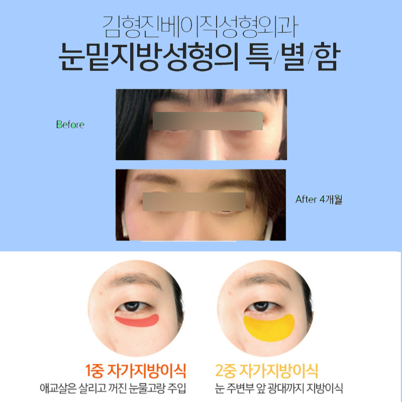 눈밑지방없애는법, 인상까지 부드러워져서 대만족이에요! 관련 이미지 5