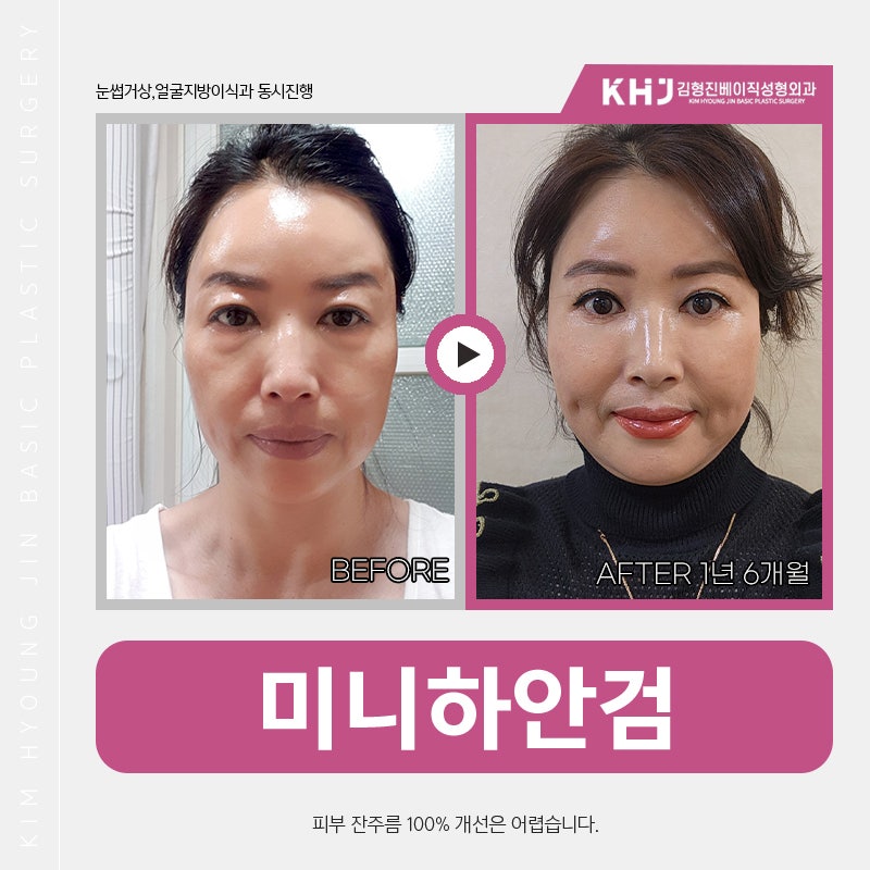 압구정하안검 김형진베이직에서 미니하안검으로 가볍게 해결해요! 관련 이미지 4