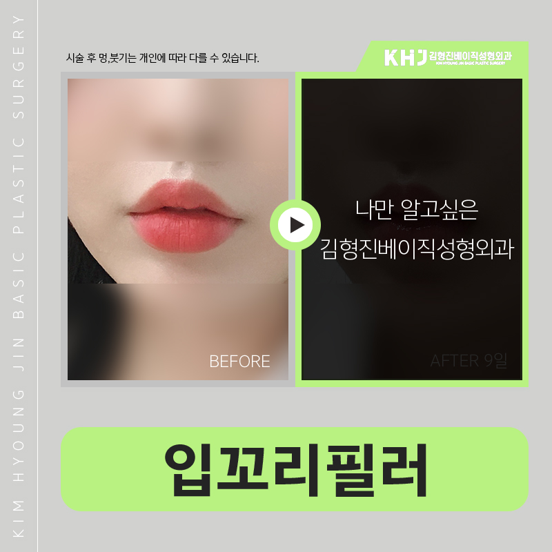 입꼬리시술 길게 고민 할 필요 없었어요 관련 이미지 5