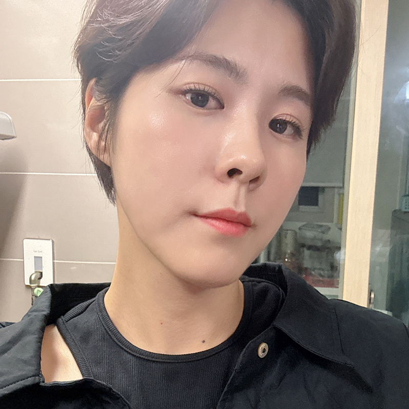 Take a look at the before-and-after of under-eye fat repositioning! image 1