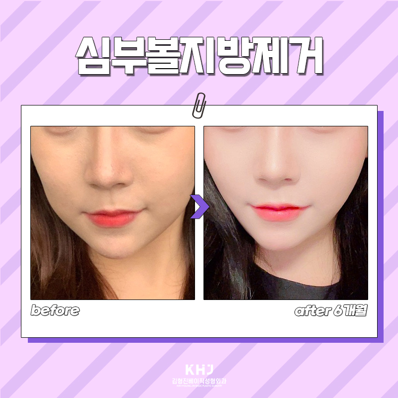 볼살제거방법으로 이 방법 선택한 합리적인 이유 관련 이미지 5