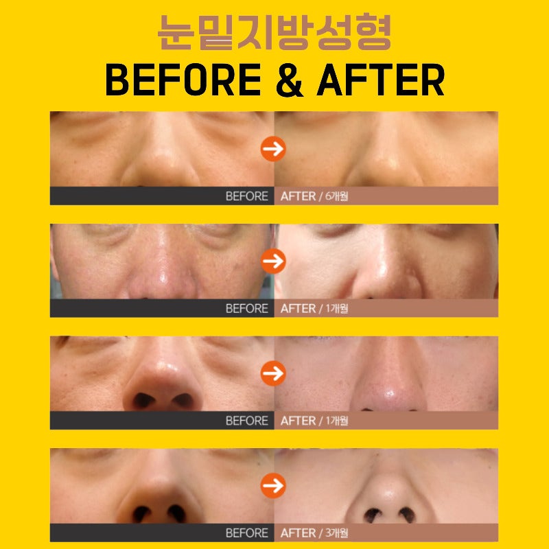 강남눈밑지 아무 데나 가면 안 돼요! 관련 이미지 6