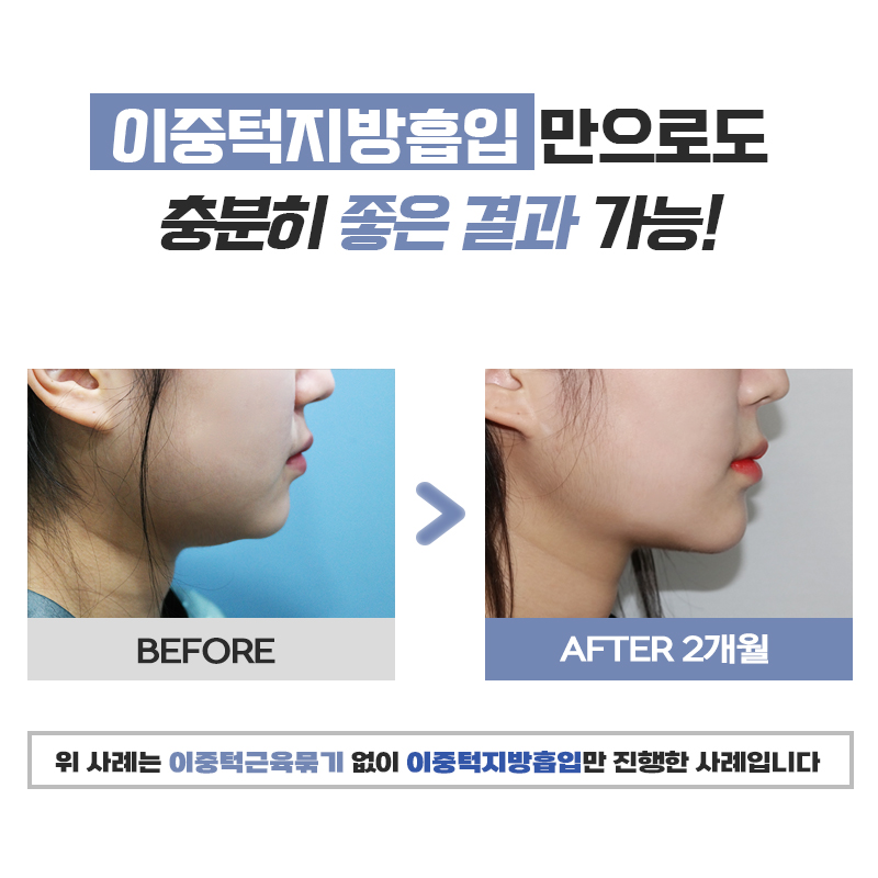 남들보다 쉽게 턱살빼는법 관련 이미지 5