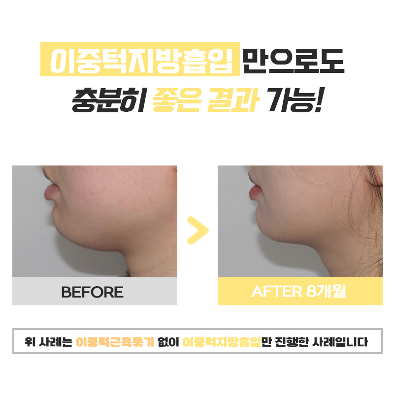 이중턱지흡후기 턱선 따라 매끄럽게 떨어지는 V라인의 비결 관련 이미지 6