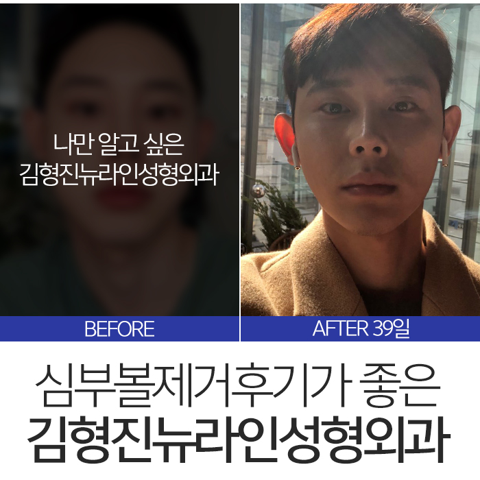 심부볼제거후기 좋을 수 밖에 없는 관련 이미지 2