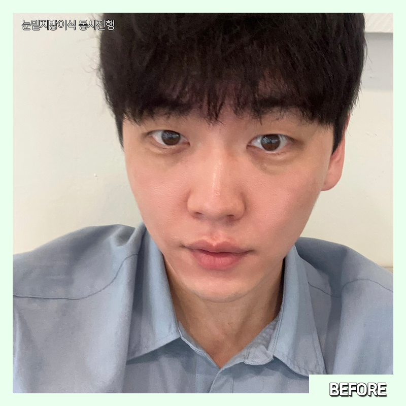 눈밑지방재배치흉터 걱정하지 마세요! 관련 이미지 3