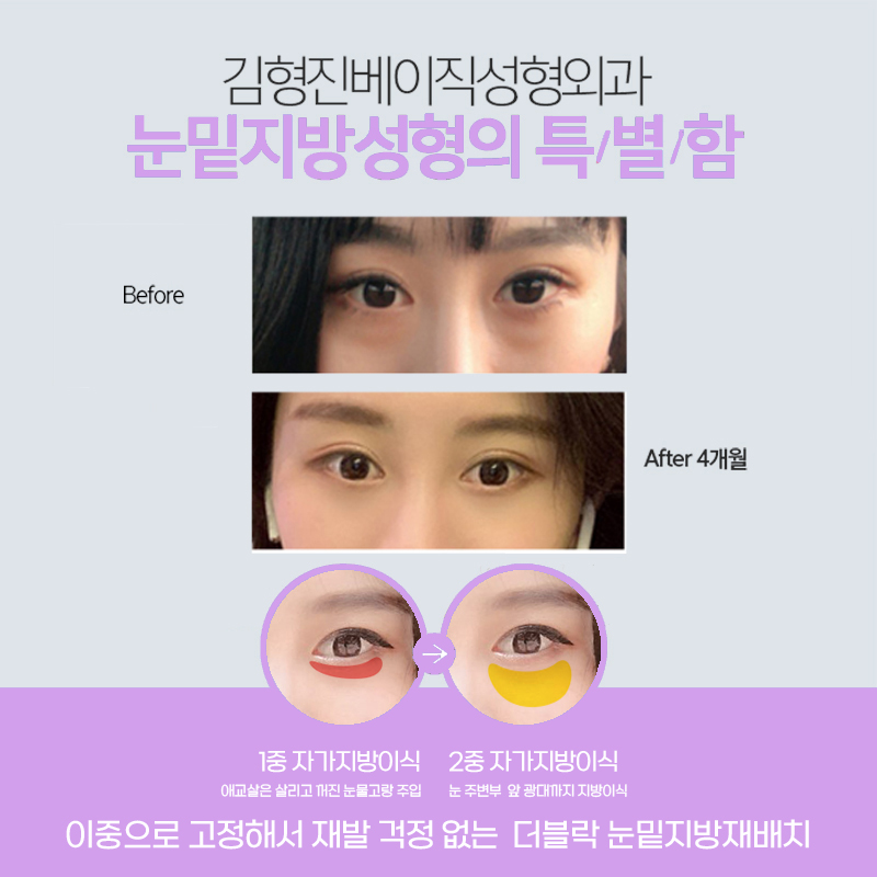 눈밑수술잘하는곳에서 재발없이 오래 유지하는 방법 관련 이미지 4