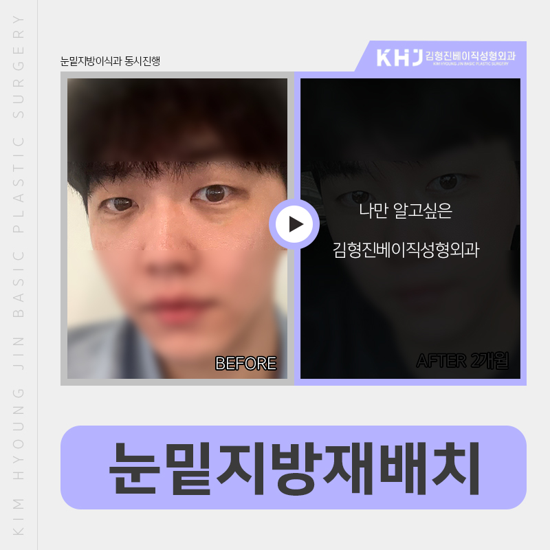 눈밑지방없애는법 김형진베이직에서는 관련 이미지 3