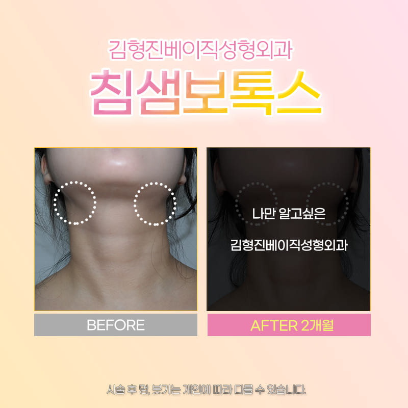 침샘보톡스추천 하면 김형진베이직 관련 이미지 5