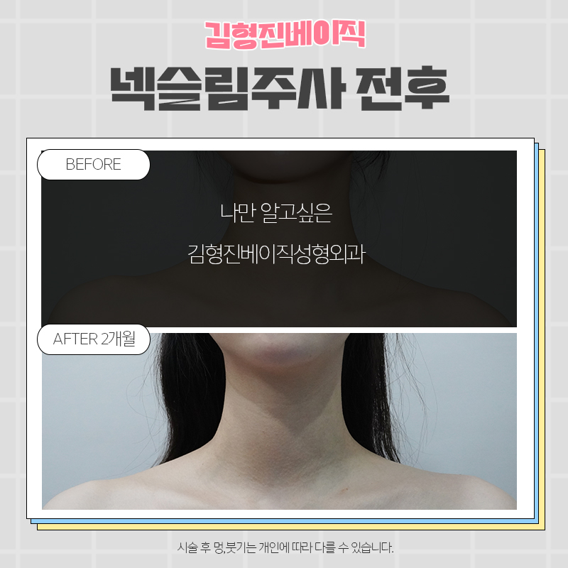 넥슬림보톡스전후 궁금하신분!? 관련 이미지 5