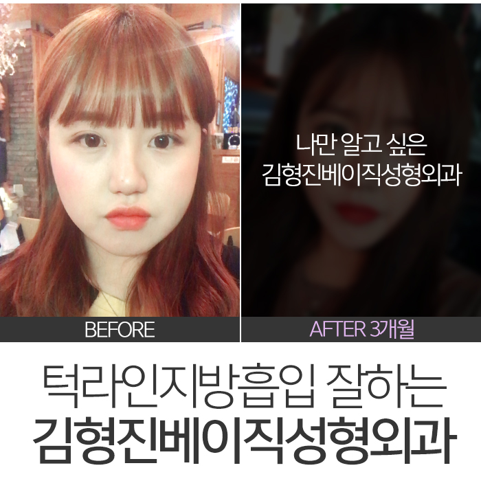 턱라인지방흡입 부담 없는 가격이죠 관련 이미지 4
