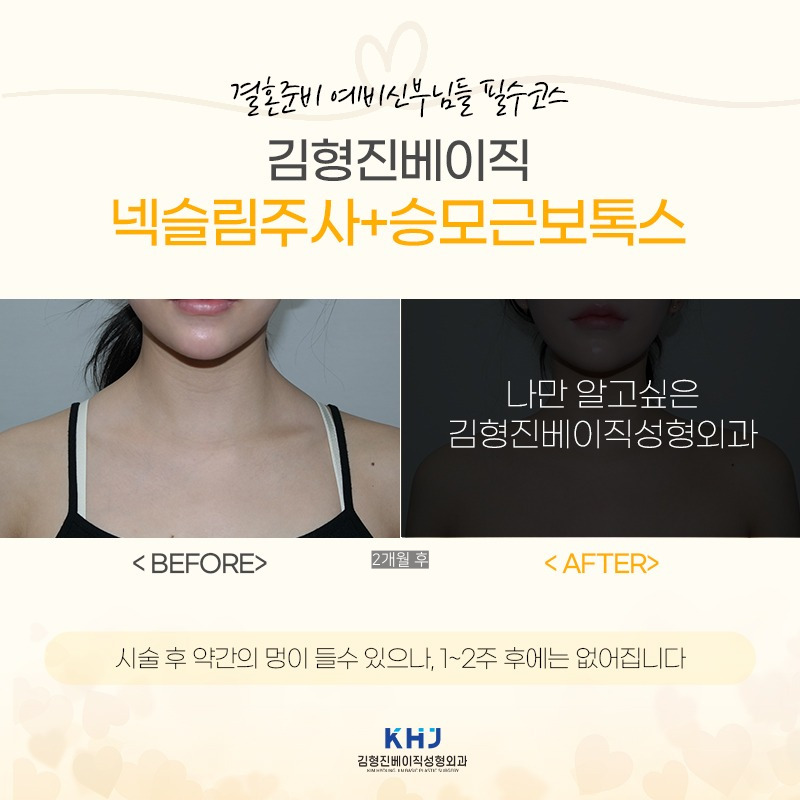 넥슬림주사효과 이런 목라인이 가능하네요..? 관련 이미지 6