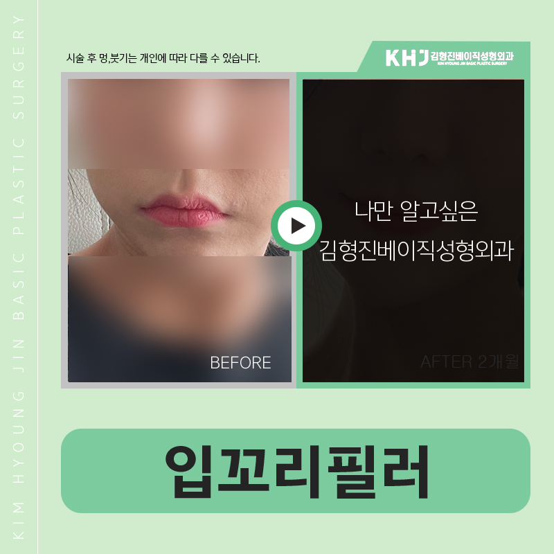 강남입꼬리필러 어디가 잘하는지 모르겠다면 관련 이미지 5