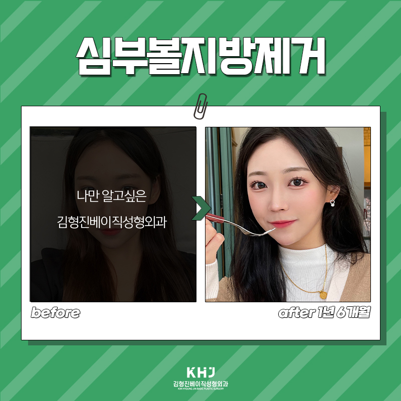 심부볼볼패임 때문에 망설이고 계신 분 들어오세요! 관련 이미지 7