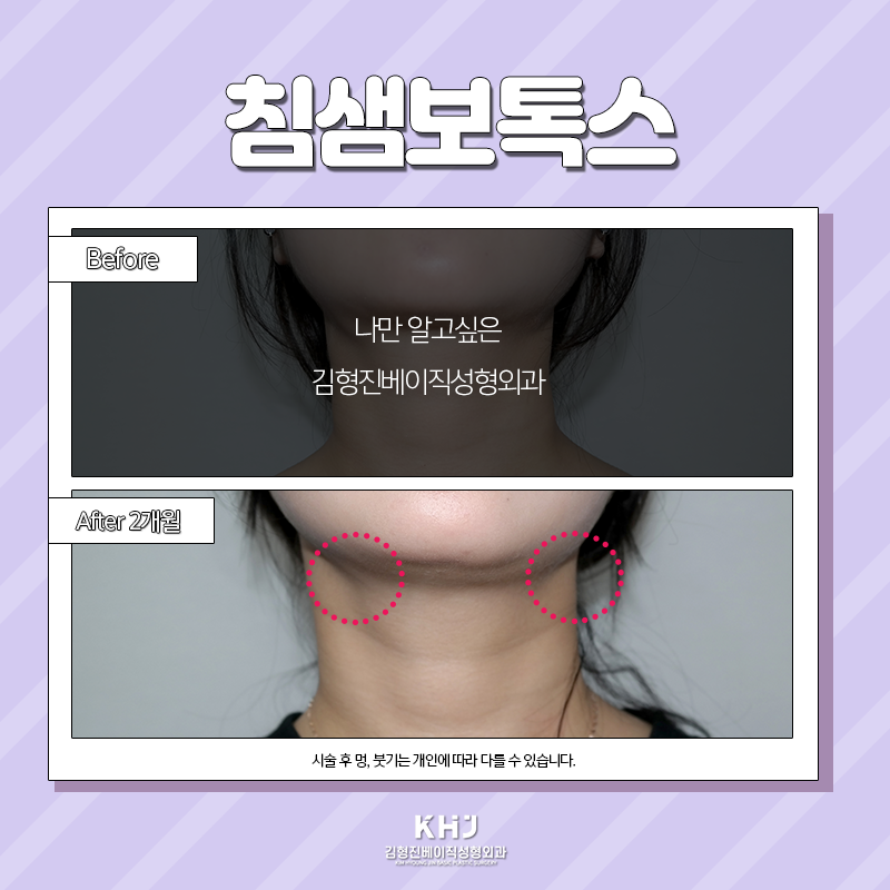 침샘보톡스효과 이렇게나 좋다구요! 관련 이미지 4