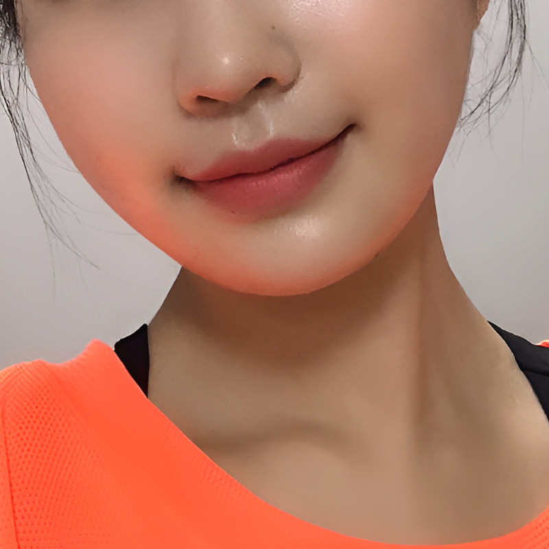 You can create more vibrant lips with just a mouth-corner filler procedure! image 2