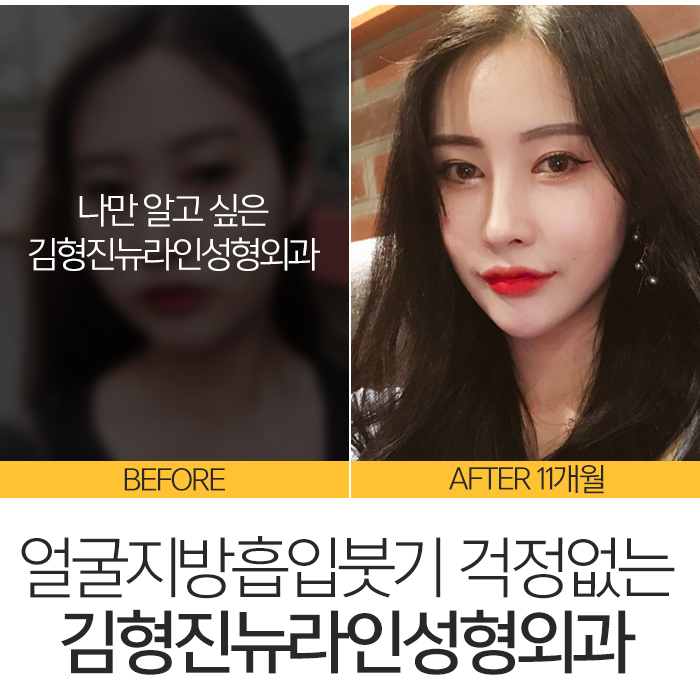 얼굴지방흡입붓기 요즘 누가 걱정해? 관련 이미지 8