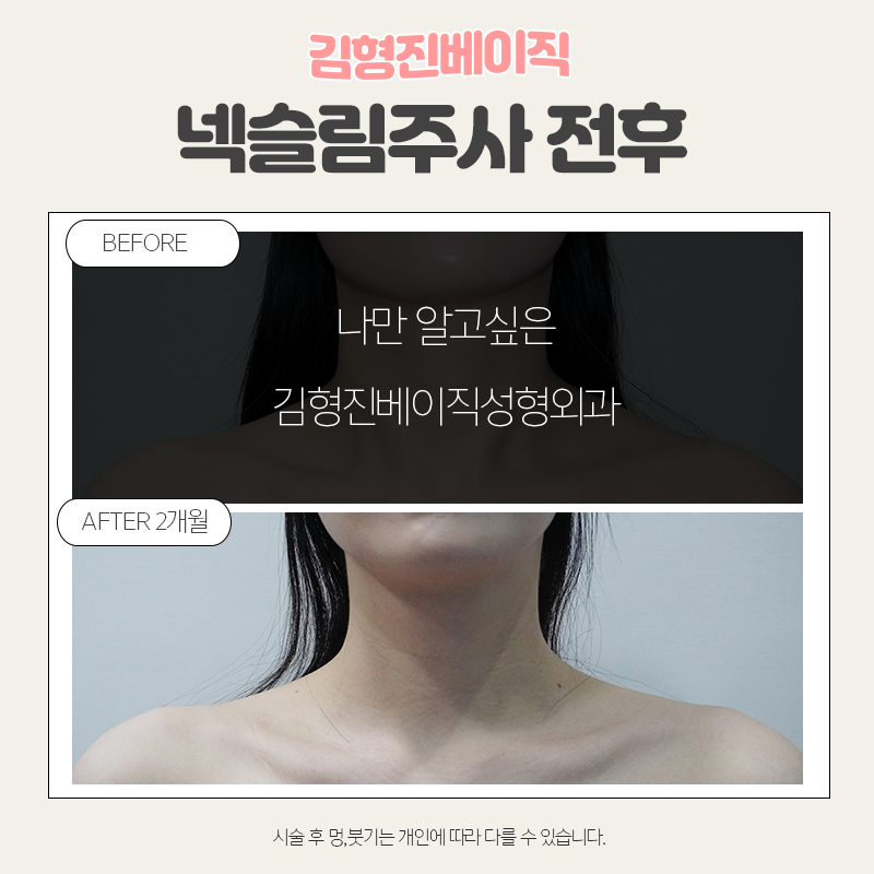 웨딩시술은 김형진베이직에서! 관련 이미지 8