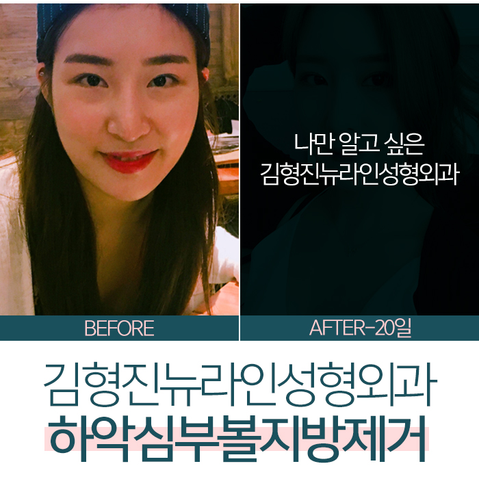 심부볼제거후기 진짜를 보여주지 관련 이미지 1