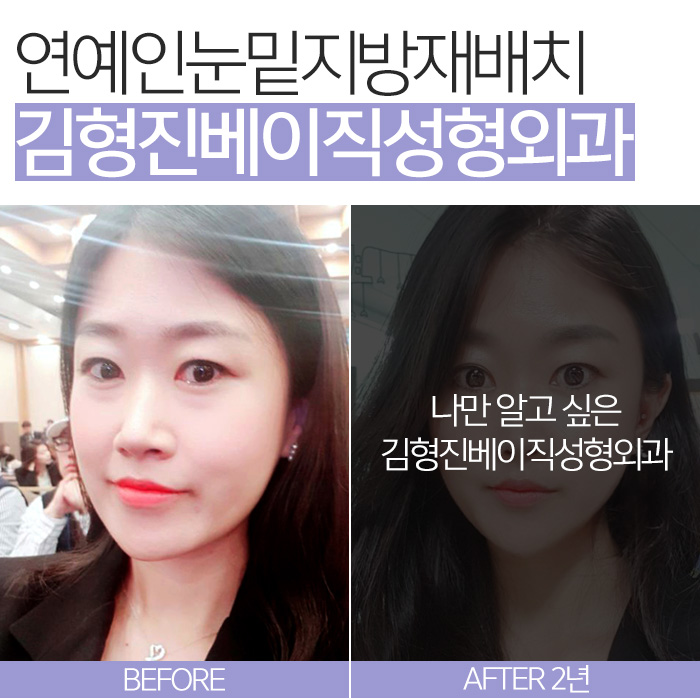 연예인눈밑지방재배치 이런 거구나 관련 이미지 8