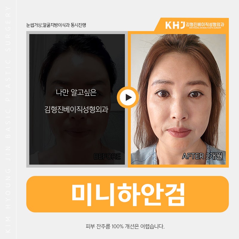 미니하안검재수술 발생 확률 적은 김형진베이직 관련 이미지 5