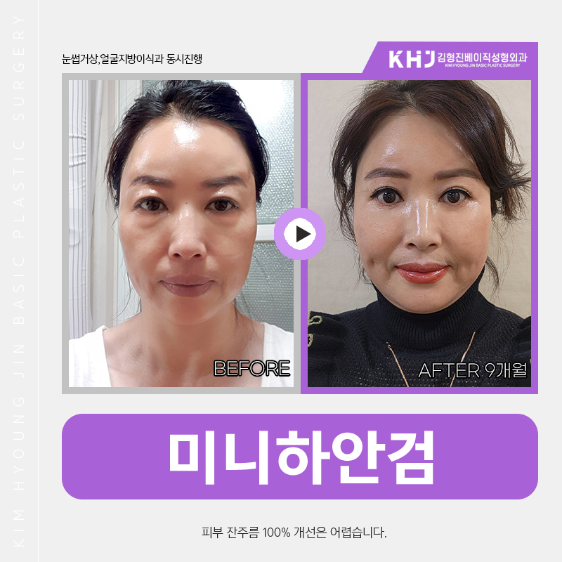 중년눈밑처짐 해결방법 찾고 계셨다면 관련 이미지 5