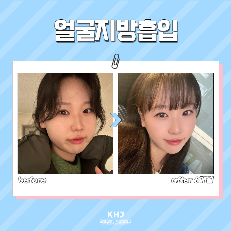 강남얼굴지흡 잘하는 곳 멀리서 찾지 마세요! 관련 이미지 7