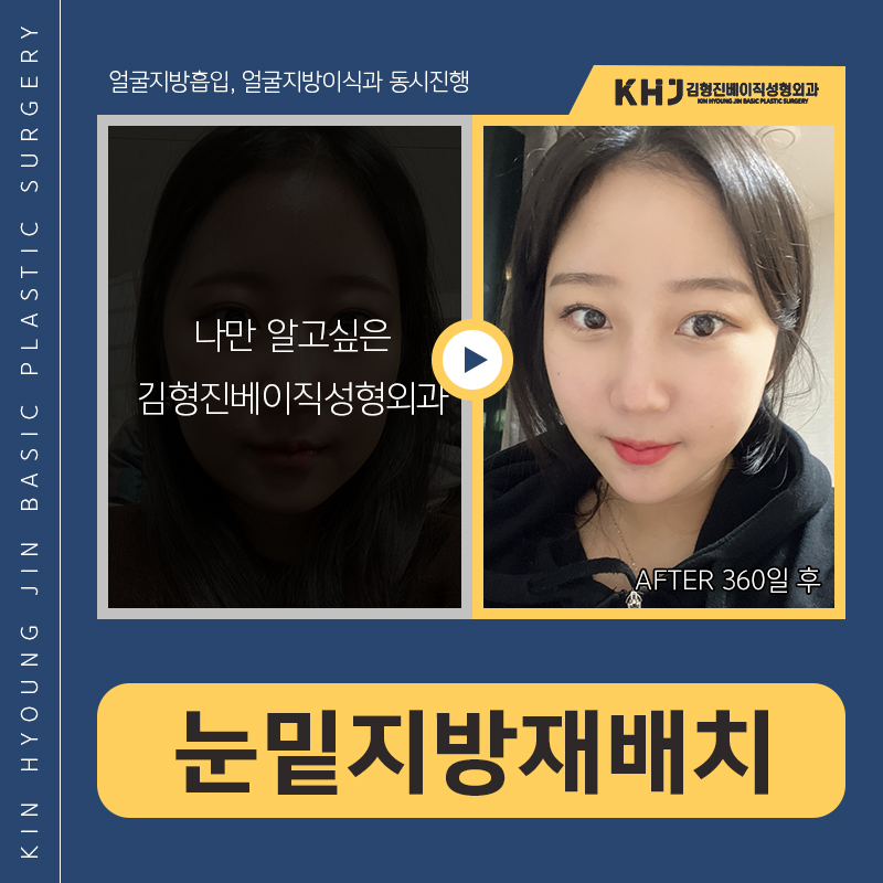 눈밑지방재배치재수술 걱정마세요 관련 이미지 4
