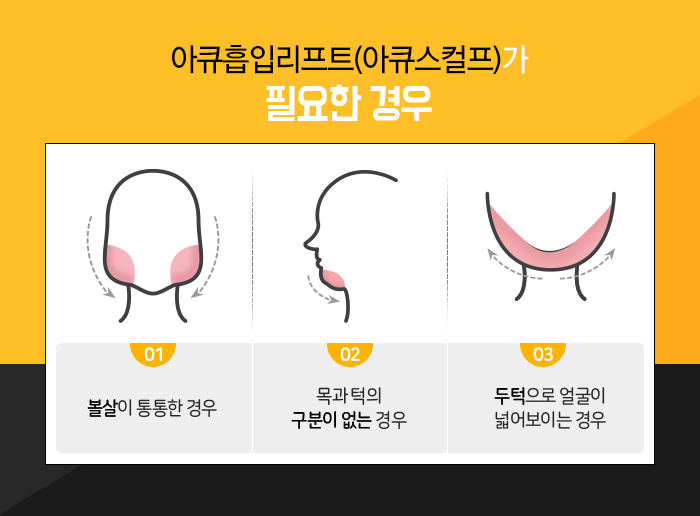 이중턱지방흡입부작용 걱정 없는데 관련 이미지 4