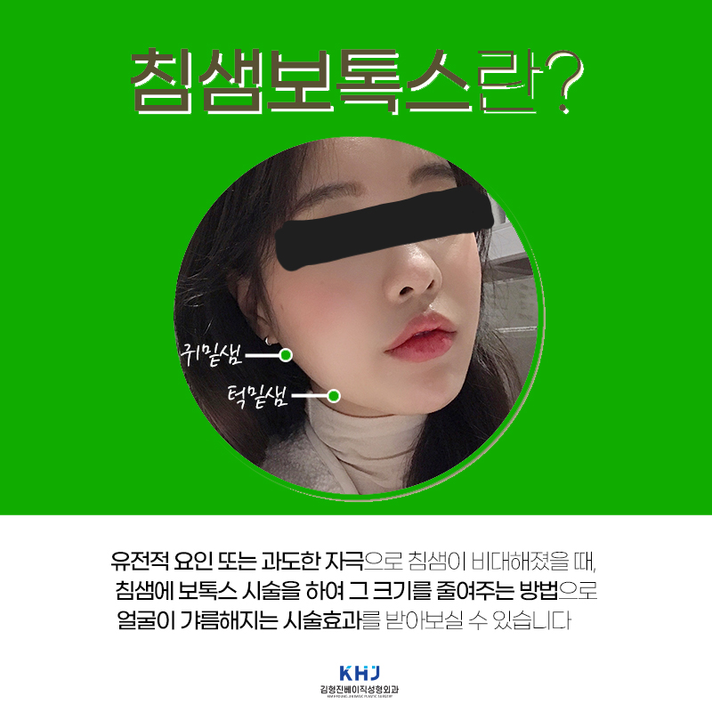 침샘보톡스 맞고 턱선 돌아왔어요 관련 이미지 4