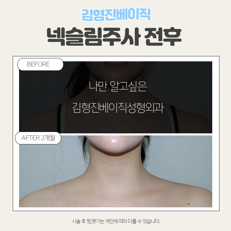 넥슬림주사시술이 궁금하시다면 관련 이미지 7
