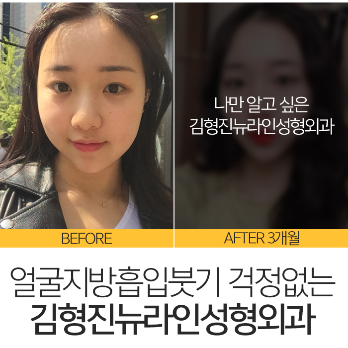 얼굴지방흡입붓기 요즘 누가 걱정해? 관련 이미지 2