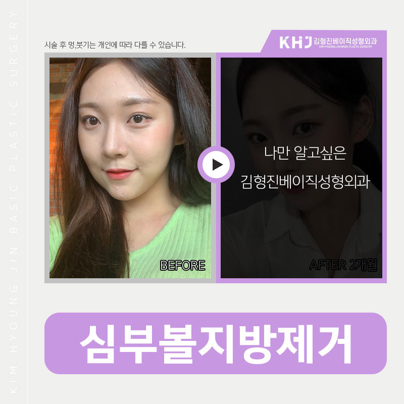 심부볼인모드로 가능할까요? 관련 이미지 3