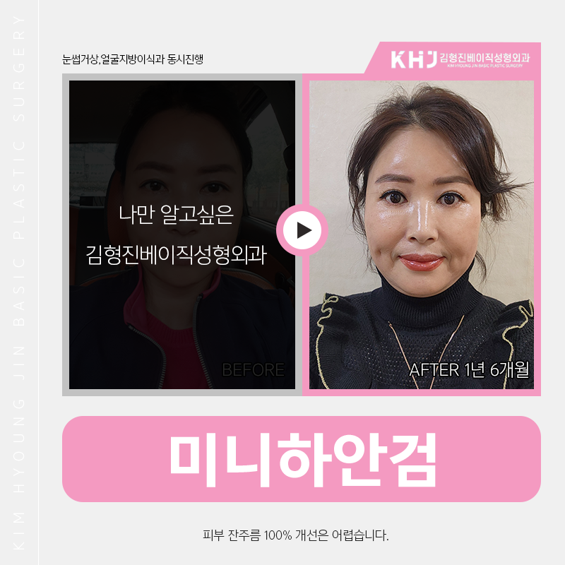 미니하안검흉터 고민은 이제 그만! 관련 이미지 5